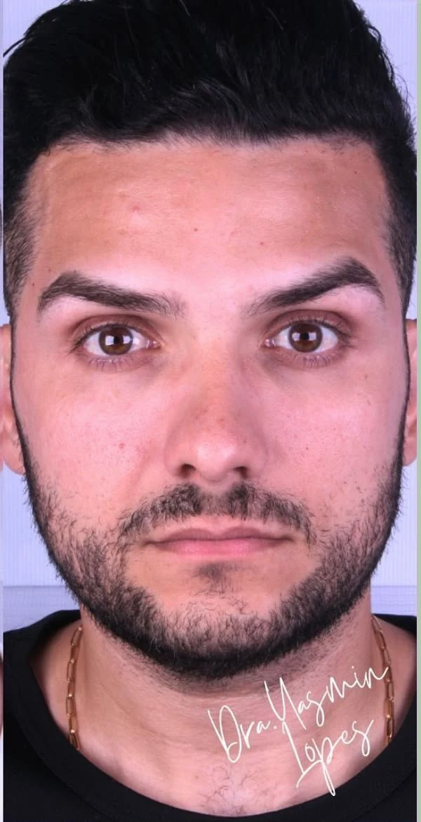 Paciente após harmonização facial em Fortaleza