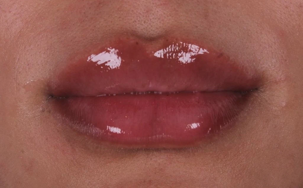 Lábios após procedimento de preenchimento labial realizado em Fortaleza